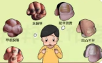 上海灰指甲去哪个医院看好-灰指甲用什么药有效