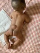 女婴半岁确诊脊柱裂大排畸报告正常 医生无资质引发争议