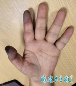 男子指尖发黑剧痛差点面临截指 医生：出现这种变化快就医