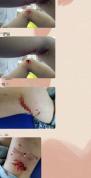 当地回应六岁女童被狗咬伤 多部门联合处置安全隐患