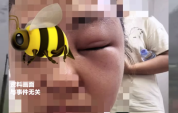 台风摧毁蜂巢致蜂群攻击性暴增 61岁大妈台风前加固晾衣架被蜇嘴唇