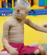 负责人回应实验事故致女孩重度烧伤！