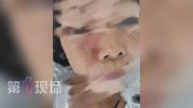 广东9岁女孩因抠鼻孔险些毁容 小动作暗藏大危机