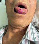 男子无三高却突发脑梗 罕见病成元凶