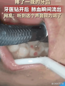 患者牙疼一夜钻开瞬间流出脓血 剧痛终得缓解