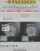 无资质养生馆扎瞎顾客右眼致其失明 3人获刑