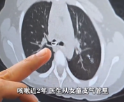 女童咳嗽2年支气管藏西瓜子 医生提醒：孩子呛咳家长切勿心存侥幸