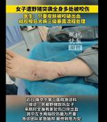 女子遭野猪突袭全身多处受伤 紧急救治转危为安
