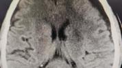 关于脑梗的三个误区 科学康复避免错误方法