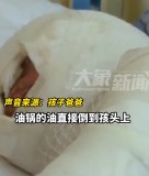 妈妈炸鸡块热油不慎从孩子头上洒下 家庭悲剧令人痛心