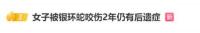 女子被蛇咬傷兩年仍有后遺癥 康復(fù)之路漫長艱難
