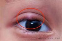 男子挤破“眼挑针”眼睛差点报废 险些危及生命