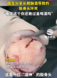医生分享长期酗酒导致的股骨头坏死 看完你还敢过量喝酒吗