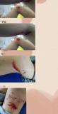 当地回应六岁女童被狗咬伤 多部门联合处置安全隐患