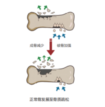 生活观察|骨质疏松不是老年人的“专属病”
