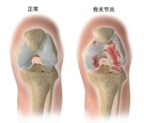 认识骨关节炎常用药：重点研读西乐葆说明书