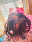 3歲女童突然脫發(fā) 查出鉈中毒 鉈中毒癥狀明顯