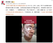 男子用餐廳毒紙巾擦臉險(xiǎn)毀容 廉價(jià)紙巾引發(fā)嚴(yán)重過敏