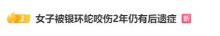 女子被蛇咬傷兩年仍有后遺癥 康復(fù)之路漫長(zhǎng)艱難