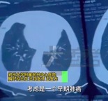爸爸每天3包烟致女儿患上肺癌 女性吸入二手烟或致肺癌发病率上升