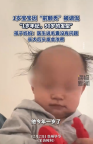 1岁宝宝因“前额秃”被调侃 孩子妈妈：医生说孩子毛囊没有问题