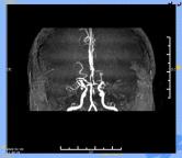 女子年年脑梗一查是罕见烟雾病 罕见病因需警惕