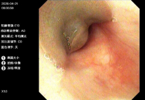 幼童反复咳血 气管内竟藏8厘米蚂蟥 成功取出活体蠕虫
