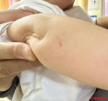 1歲寶寶小區(qū)玩耍被蛇咬傷 醫(yī)生提醒 警惕蛇毒潛伏期