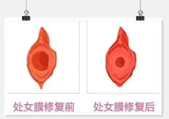 近期要闻：重庆哪里做处女膜修复手术更可靠？口碑响亮重庆军科整形美容医院私密科处女膜修复效果好！