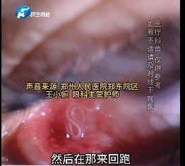 女子眼癢竟從眼睛里取出活蟲 結(jié)膜吸吮線蟲作祟