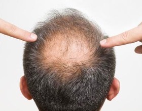 如何饮食预防脱发 有哪些偏方可以防止脱发