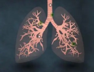 肺癌的放射性治疗具体指什么 肺癌放疗的副作用该如何应对