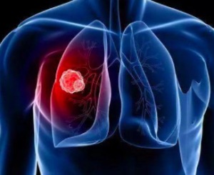 生物免疫治疗肺癌的优势有哪些 具有滋阴养血功效的肺癌偏方有哪些