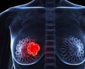 爱吃高热量食物增大乳腺癌风险 为何会如此早的患上乳腺癌？