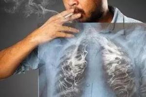 肺癌患者吃白萝卜可止咳吗 肺癌术后如何预防褥疮发生