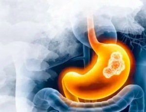 胃癌早期征兆有哪些 谁是胃癌的高危人群？