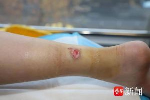 女孩连贴几晚暖宝宝三度烫伤 低温烫伤需警惕