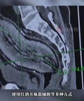 男子将红薯塞入肛门手术取出 医生多番尝试终成功