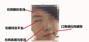 19岁男生寒假疯玩一觉睡醒脸歪了 假期过度放纵引发面瘫