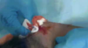 27岁女子1周前挤痘痘1周后高烧40度 确诊2型糖尿病