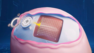 “北脑一号”脑机接口进入临床研究 助力高位截瘫患者康复