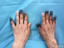 驢友徒步凍傷7根手指壞死 高原探險(xiǎn)代價(jià)沉重