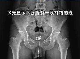 28岁男子尿道塞数据线硬撑12小时 好奇探索酿成险情