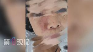 广东9岁女孩因抠鼻孔险些毁容 小动作暗藏大危机
