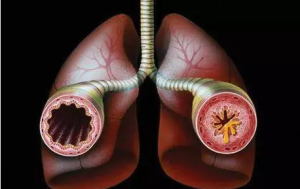 困扰近亿人的慢阻肺究竟是什么？被称为“沉默的杀手”！