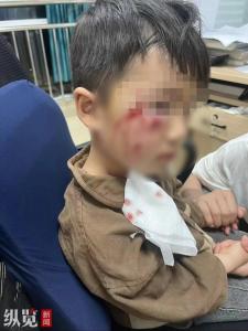 河南3岁男童被恶犬咬伤18天后离世 悲剧引疫苗接种反思