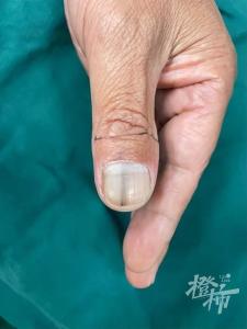 指甲上长出黑线会癌变吗？专家解析指甲健康警讯