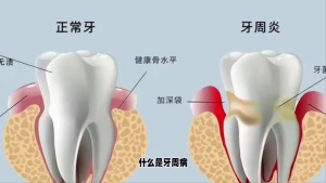 我國90%以上成年人有牙周疾病 口腔健康關乎全身健康