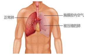 演员白宇因患气胸做过6次手术 分享经历呼吁关注