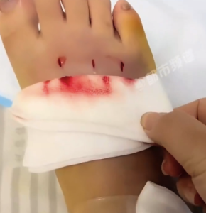 女生河邊散步腳被蝮蛇咬三個(gè)洞：幸好毒性不大 打完血清后沒事了